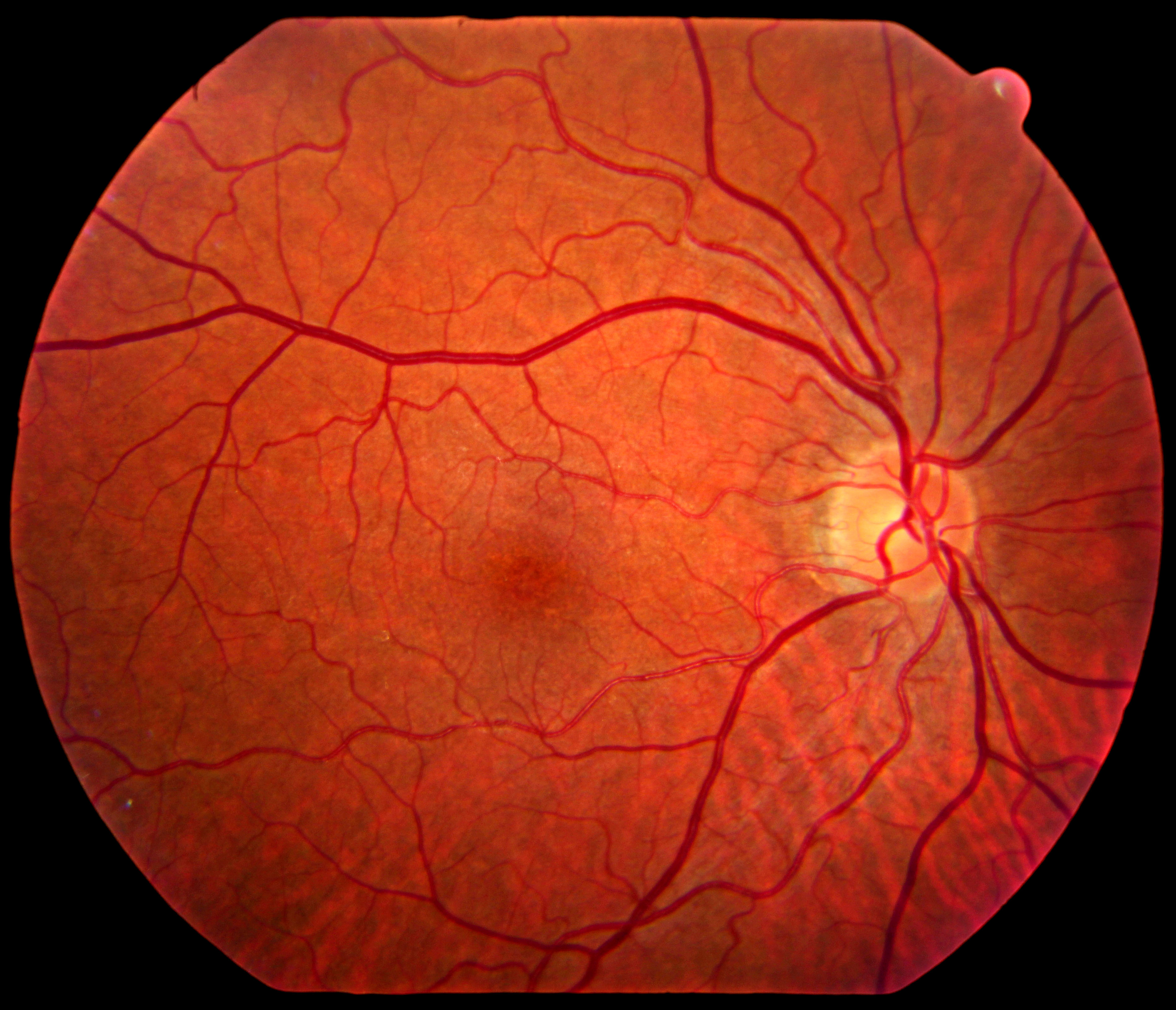 Изображение пропадает если расположено впереди сетчатки. Эмболия центральной артерии сетчатки глаза. Неоваскулярная глаукома. Плаквениловая ретинопатия.