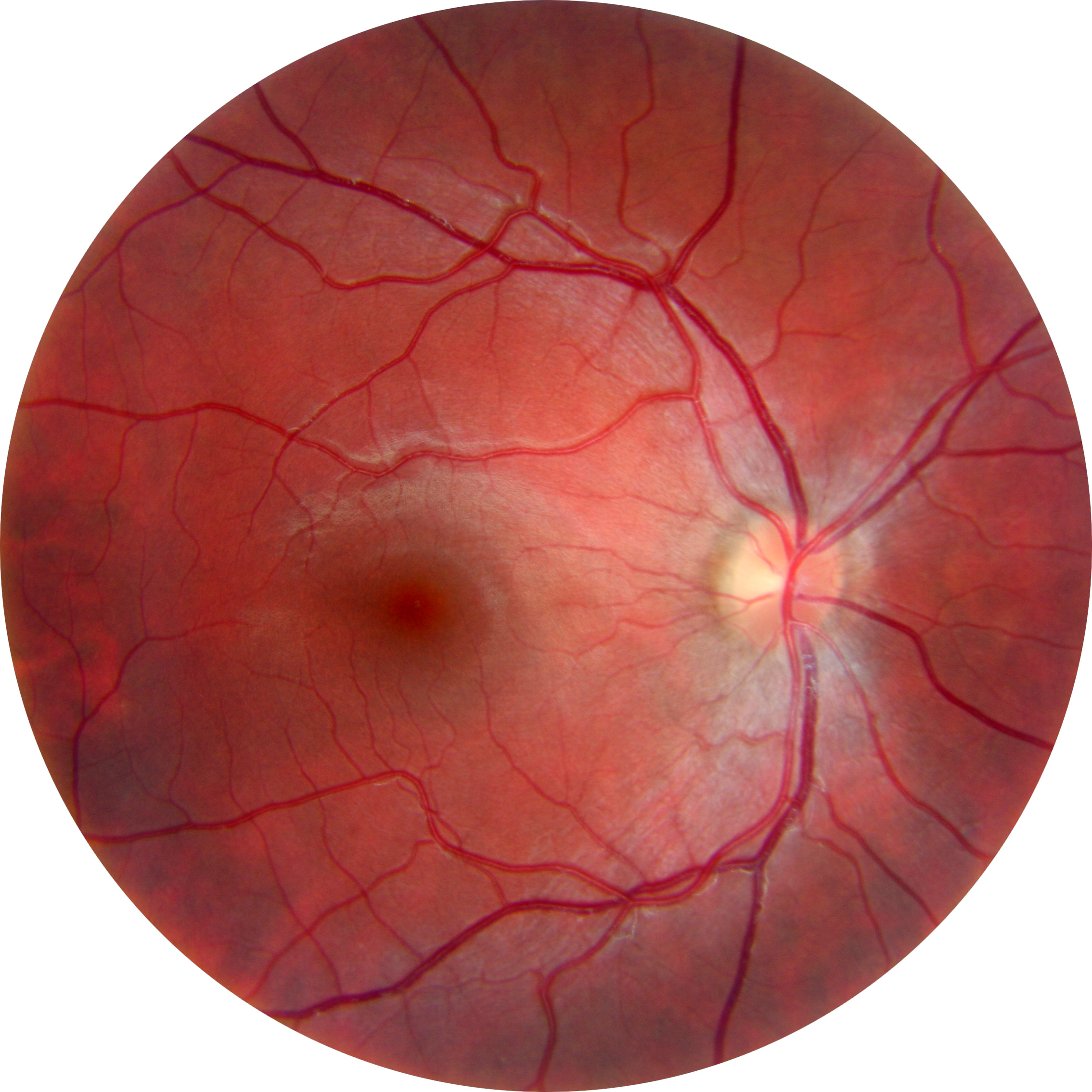 TRC-NW6 TRC-NW6 sample retinal image